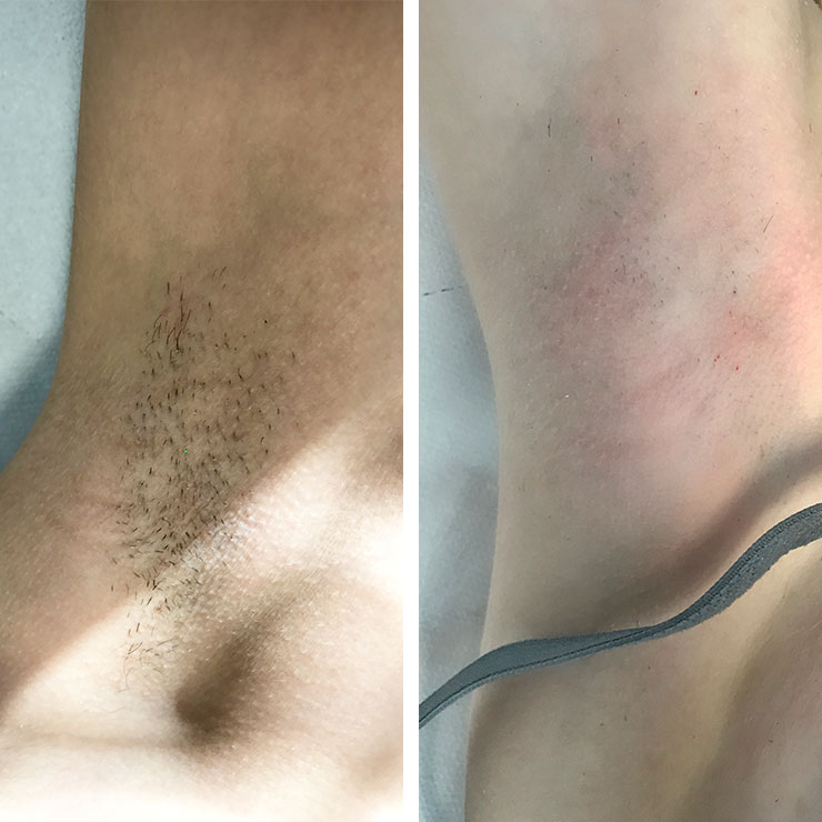 Thick, dark underarm hair