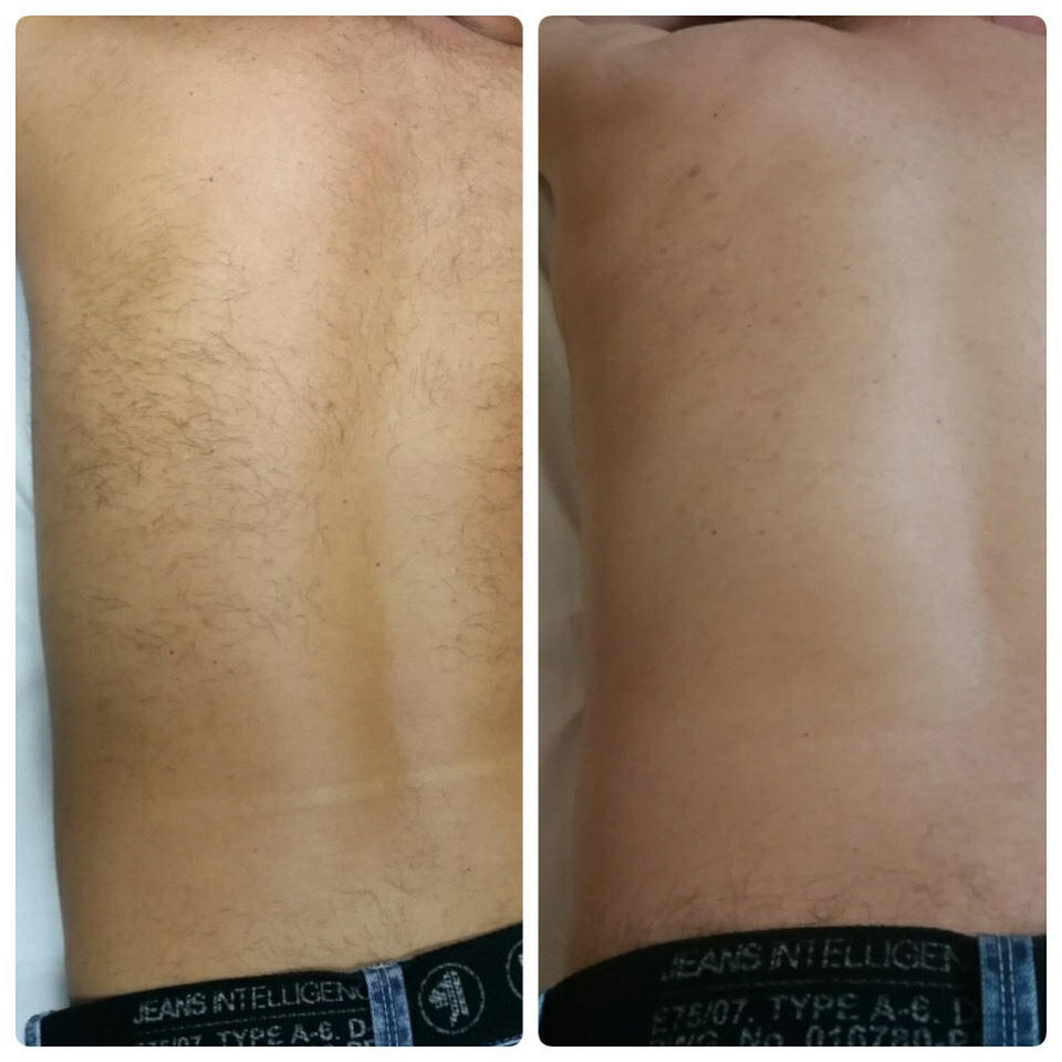 Laser hair removal for men